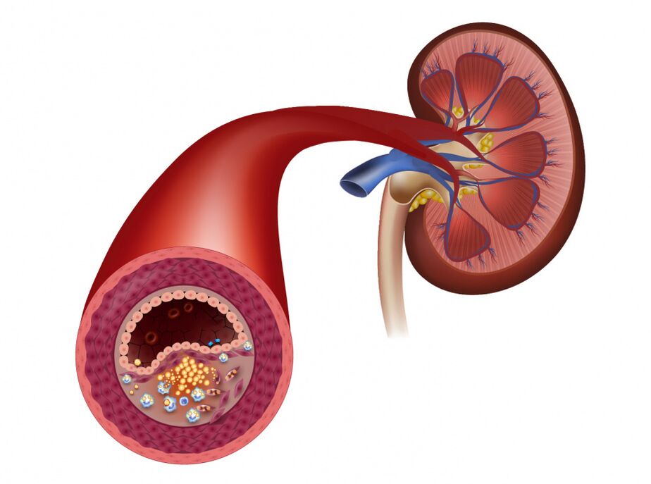Reduce blood flow due to atherosclerosis